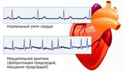 Аритмия мерцательная