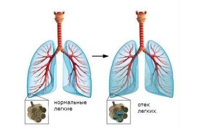 Отек легких