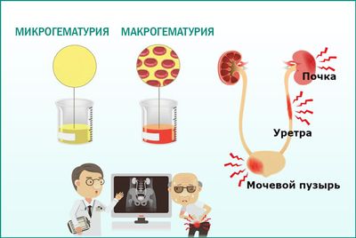 Макрогематурия и микрогематурия