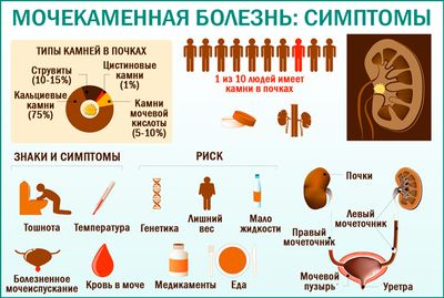 Симптомы проявления мочекаменной болезни