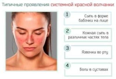 Симптомы системной красной волчанки