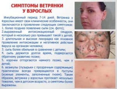 Проявления ветряной оспы
