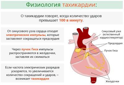 тахикардия