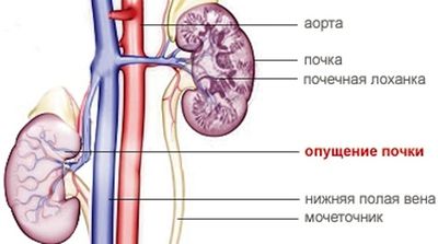 опущение почки