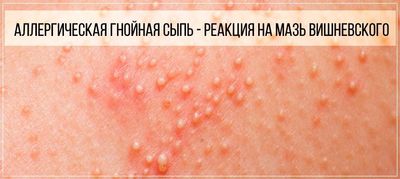 Аллергия на мазь Вишневского