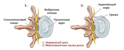 Лечение и первые признаки грыжи пояснично-крестцового отдела позвоночника