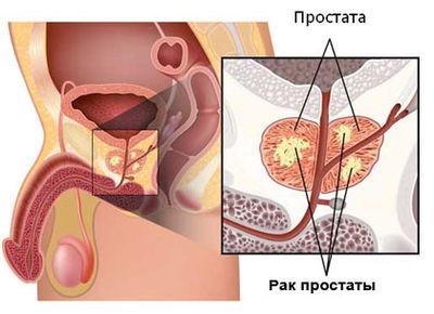 Рак простаты