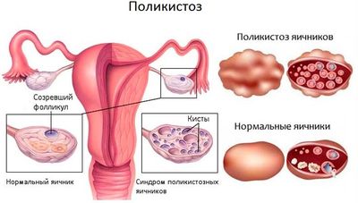поликистоз