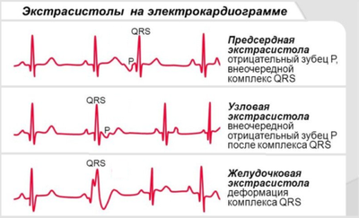 Разновидности экстрасистолии