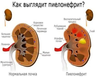 пиелонефрит
