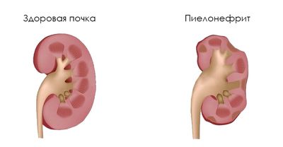 пиелонефрит