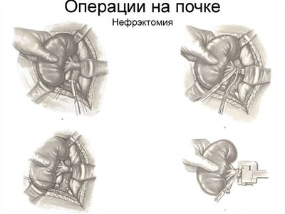 нефрэктомия