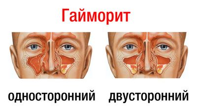 гайморит