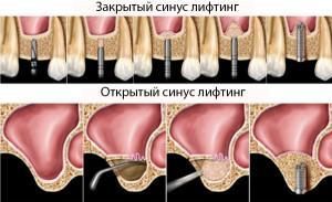 Особенности открытого и закрытого синус-лифтинга в стоматологии: рекомендации после проведения операции, осложнения