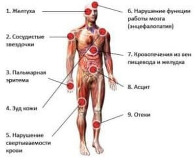 Признаки поражения печени