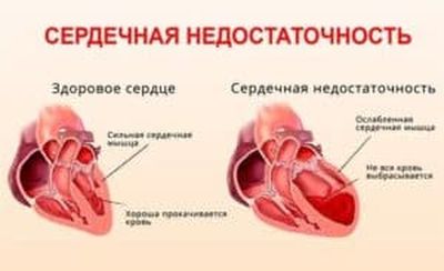 Сердечная недостаточность