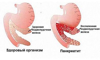 Панкреатит