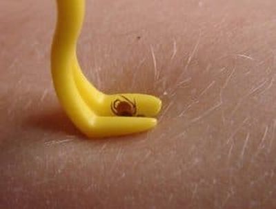 Удаление клеща специальным пинцетом