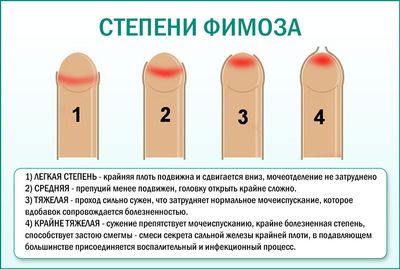 Фимоз: степени