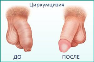 Циркумцизио