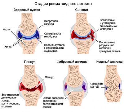 Стадии ревматоидного артрита