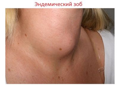 эндемический зоб