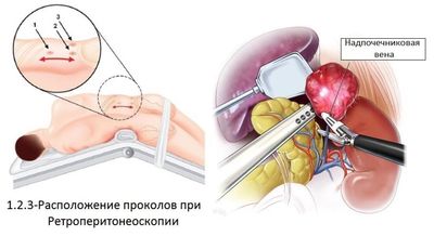 адреналэктомия техника выполнения схема