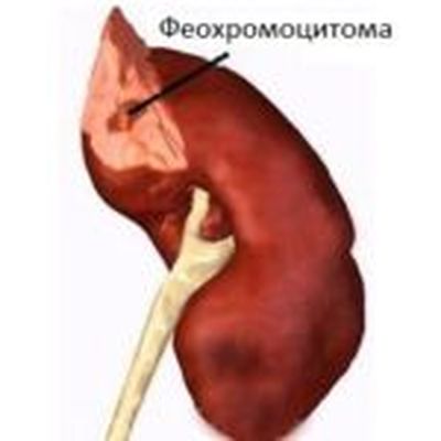 феохромоцитома опухоль надпочечников