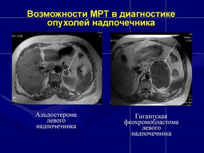 МРТ в диагностике опухолей надпочечника