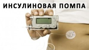 Инсулиновая помпа