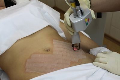 Средства борьбы с растяжками на бедрах после родов