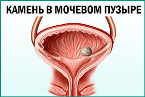 Мочекаменная болезнь