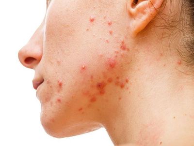 Средство используют в терапии угревой сыпь