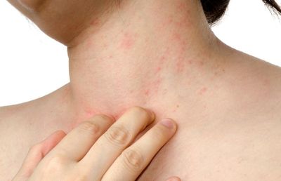 Кожный зуд и покраснения -признаки аллергии на средство