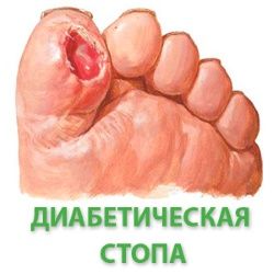 Мазь солкосерил назначают при диабетической стопе
