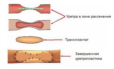 уретропластика