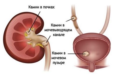 мочекаменная болезнь