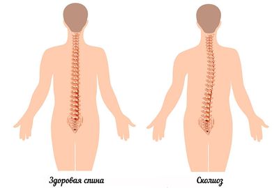 сколиоз