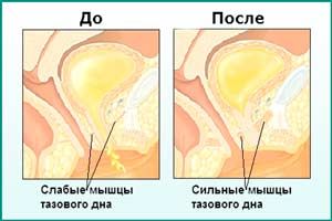 Упражнения Кегеля для мужчины при простатите: результаты