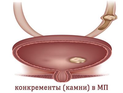 obrazovanie-konkrementov