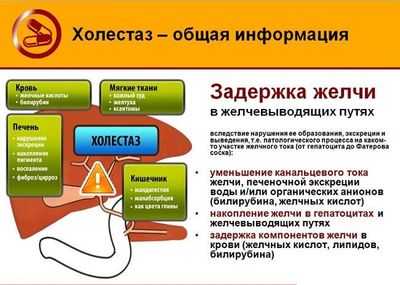 холестаз