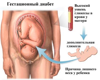 Гестационный диабет