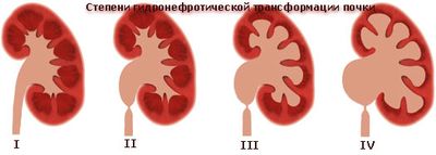 гидронефротическая трансформация почки