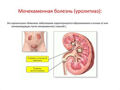 уролитиаз