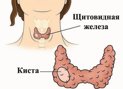 кистапаращитовидной железы
