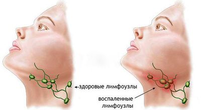 Лимфаденит-1