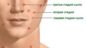 simptomy-vetryanki