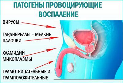 Простатит возникновение