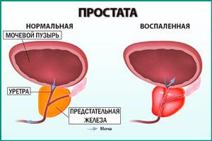 Воспаление простаты