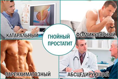 Виды гнойного простатита